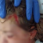 Šok obrt u Prijepolju! Pit bul koji je napao dijete nije moj nego lutalica?! Devojčica (7) ima traume, ne spava i ne jede