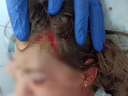 Šok obrt u Prijepolju! Pit bul koji je napao dijete nije moj nego lutalica?! Devojčica (7) ima traume, ne spava i ne jede