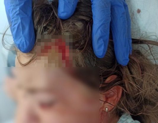 Šok obrt u Prijepolju! Pit bul koji je napao dijete nije moj nego lutalica?! Devojčica (7) ima traume, ne spava i ne jede