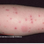 Mještani Selakovca ne izlaze iz kuće zbog najezde buva: “Djeca izujedana, strah se širi kroz naselje” (VIDEO)