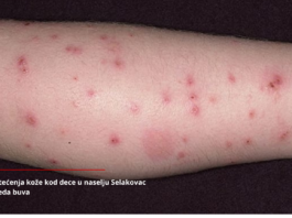 Novi Pazar – Poslali epidemiologa da vide kakve to buve napadaju građane, vratio se sa preko 50 ujeda (VIDEO)