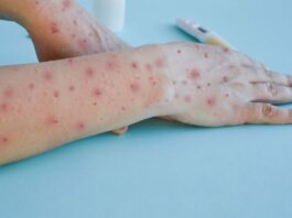 U avgustu skoro sto novoobolelih od morbila, najviše u Novom Pazaru