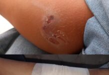 Još jedan napad psa na dijete u Novom Pazaru, od azila još uvek ništa (VIDEO)