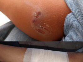 Još jedan napad psa na dijete u Novom Pazaru, od azila još uvek ništa (VIDEO)