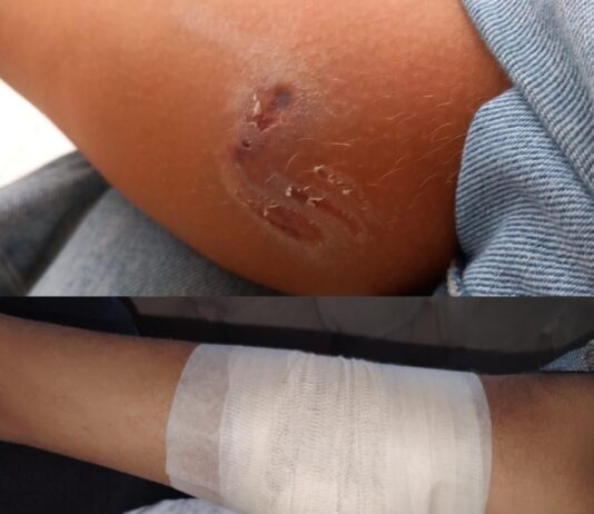 Još jedan napad psa na dijete u Novom Pazaru, od azila još uvek ništa (VIDEO)